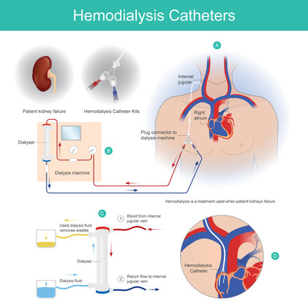 Hemodialysis Catheters. A dialysis catheter is a catheter used for exchanging blood from heart to and from a hemodialysis machine and a patients.のイラスト素材