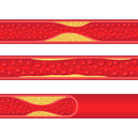 Arteriosclerosis vector design illustration isolated on white backgroundのイラスト素材