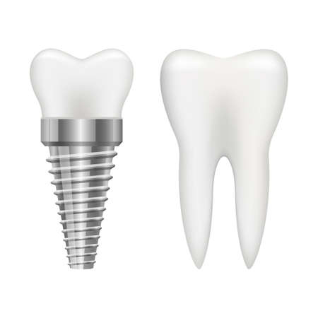 Tooth implant vector design illustration isolated on white backgroundのイラスト素材