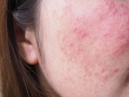 Red rash on young Asian Thai woman face, Itchy and allergic skin problems, dermatitis.