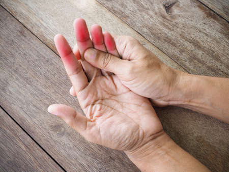 Closeup of body asian thai people with hand injury, palm, bone joint pain fingerの写真素材