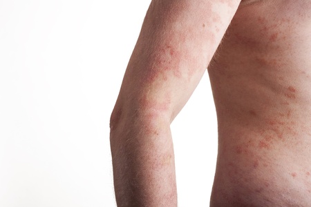 Psoriasis on the bodyの写真素材