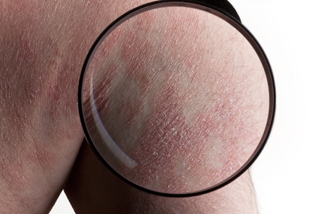 Psoriasis medical examの写真素材