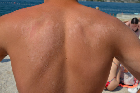 Man with sunburned skin on the back of the body.の写真素材