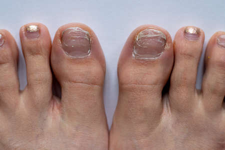 broken nails during lock down in Germany, while all beauticians were closedの写真素材