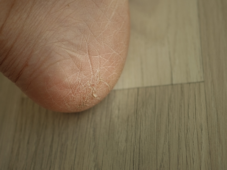 cracked foot close up.の写真素材