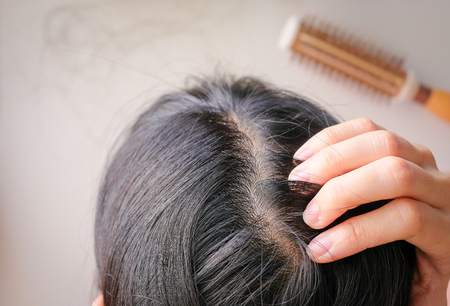 hair fall and lost alopecia woman problem on the comb.の写真素材