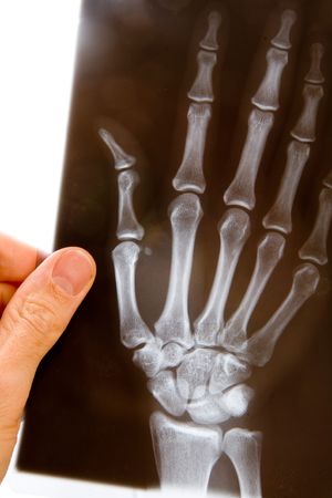 A male doctor holds up an x-ray of a hand to examine itの写真素材
