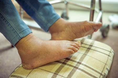 Elderly foot care. Old Asian Indian woman with bare feet, oedema with swollen feet and ankles, UKの写真素材