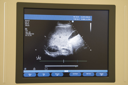 Closeup of an image on computer screen of ultrasound scanning machine in hospitalの写真素材