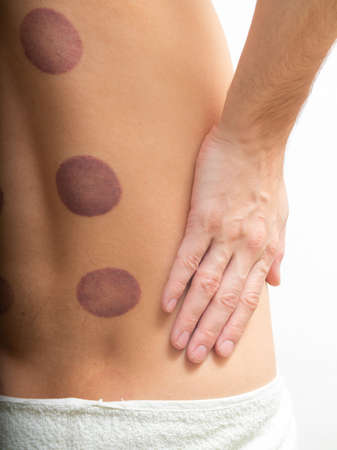 back close-up with traces of treatment jars. Traditional medicine, acupuncture and back massage