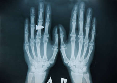 A x-ray of both human hand picture の写真素材