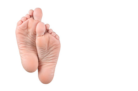 Dry and cracked soles of feet on white background. rough skin on female feet isolated on white background. Close up of Cracks on Heels with bad covered skin. Health care and medical concept.の写真素材