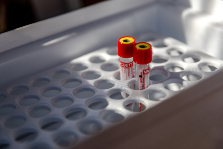 MINSK, BELARUS - 1 JUNE, 2019: drug addict is tested for HIVのeditorial素材