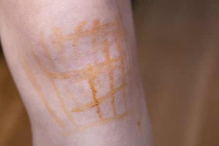 Iodine net on the knee of a person. Sports injury treatmentの写真素材