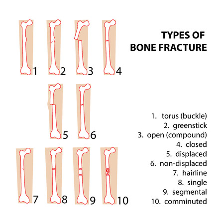 types of bones fractures. vector format illustrationのイラスト素材