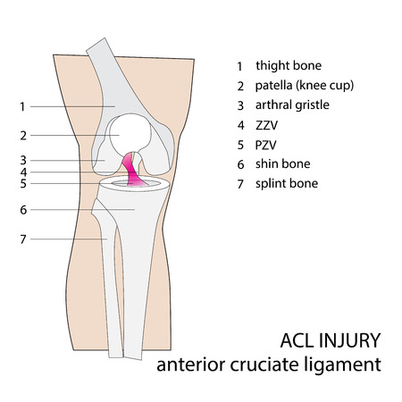 ACL. anterior cruciate ligament. vector format illustration.のイラスト素材