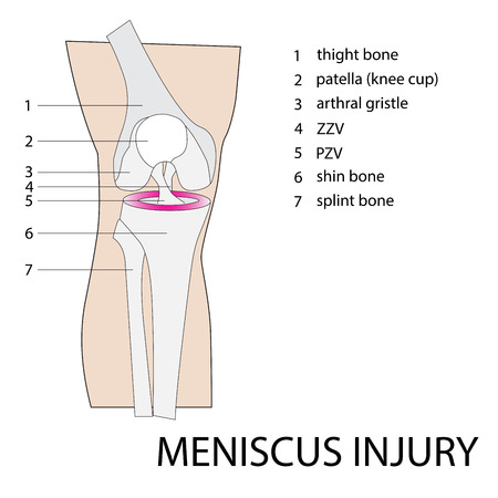 vector format illustration of a knee meniscus injuryのイラスト素材