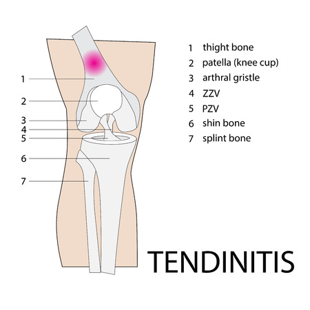vector format illustration of tendinitis knee injuryのイラスト素材