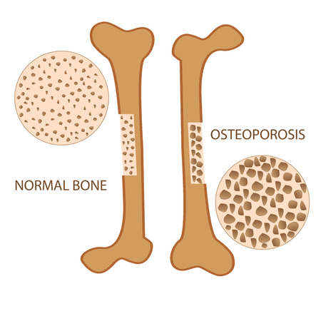 osteoporosis bone anatomy versus normal bone health. vector format illustrationのイラスト素材