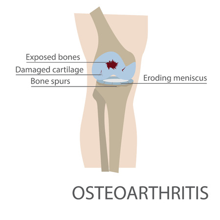 osteoarthritis human knee joint disease. vector format illustrationのイラスト素材