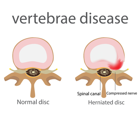 back pain. herniated disc. vertebrae disease vector formatのイラスト素材