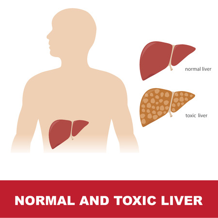 vector illustration of a comparison of healthy and toxic liverのイラスト素材