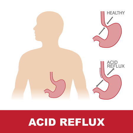vector illustration of comparison of healty and stomach with acid refluxのイラスト素材