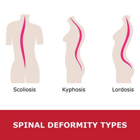 scoliosis, lordosis and kyphosis. Illustration of a spinal deformity types.のイラスト素材