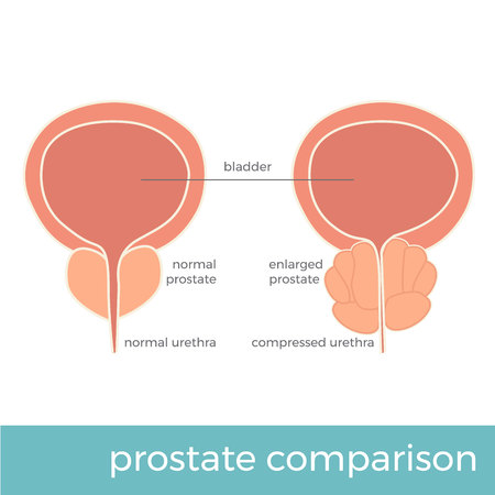 vector illustration of normal and enlarged prostate comparison.のイラスト素材