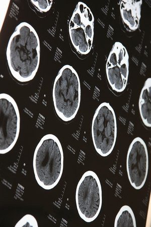 CT scan