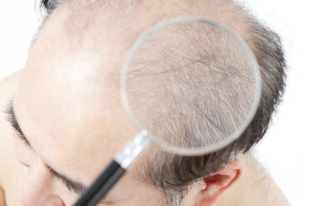Thinning hair it is enlarged by a magnifying glassの写真素材