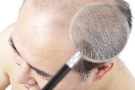 Thinning hair can be examined by magnifying glass manの写真素材