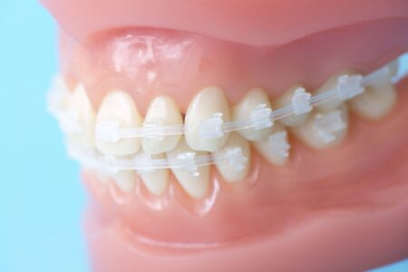 Model of teeth with orthodontic appliances