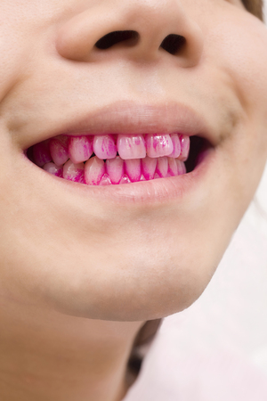 Mouth of plaque stained menの写真素材