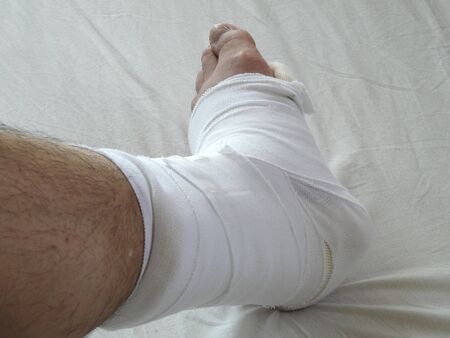 Gibbs of ankle fracturesの写真素材
