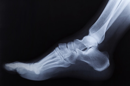 Broken right foot ankle Xray, side viewの写真素材