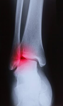 x-ray image of human foot joint , back viewの写真素材