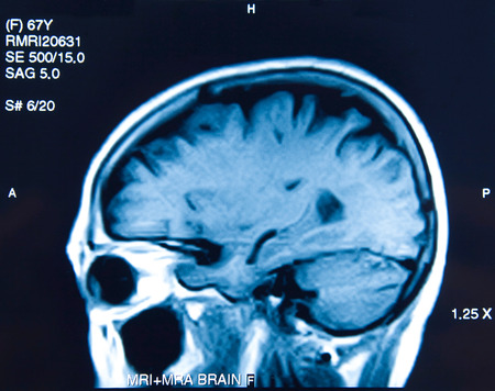 Closeup of a CT scan of 67 year old woman brain.