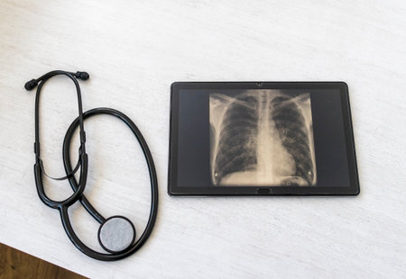 Table with phonendoscope, and a X ray image of the lungs with pneumonia on the tabletの写真素材