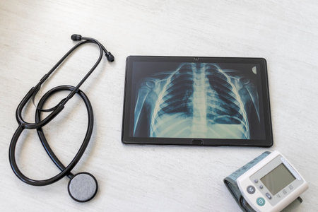 Table with phonendoscope, sphygmomanometer and a X ray image of the lungs with pneumonia on the tabletの写真素材