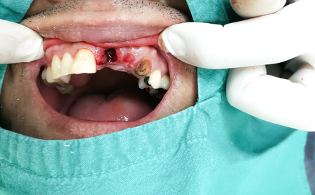 Closed up unknown patient's mouth, showing newly pulled tooth and a tooth with decay. Bad mouth health.の写真素材