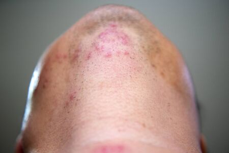Young men who are sick are herpes zoster at the face and throat