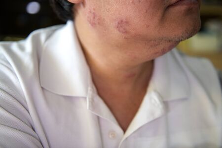 Young men who are sick are herpes zoster at the face and throatの写真素材