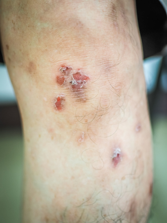 The scabs of the dermatologist on the knee. Close up and selective focus