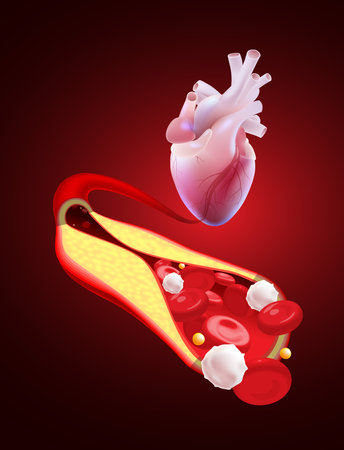3D illustration of a blocked human coronary artery presents a close-up view of the blood vessel cross-section and dissecting it to reveal the inside. Used in medicine, education, science and industry.のイラスト素材