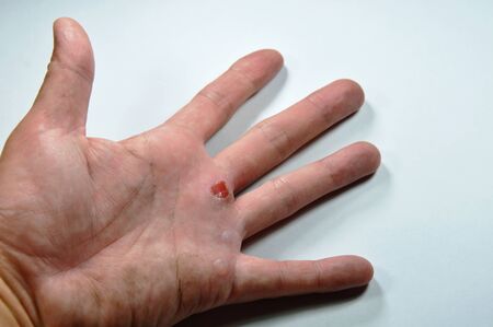 blister on hand after workの写真素材