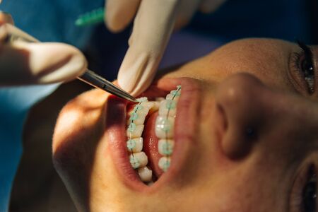 process of placing white dental braces to a Caucasian girl in a dental clinic with a dentist girl....