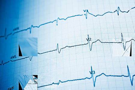 Close up of an electrocardiogram in paper form.の写真素材