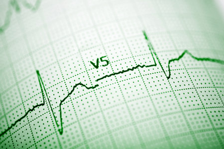 Electrocardiogram showing the pulse of the human heartの写真素材